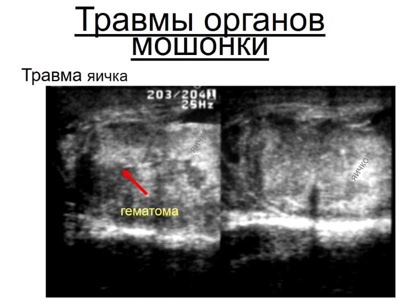 Травмы органов мошонки Травма яичка яичко гематома яичко